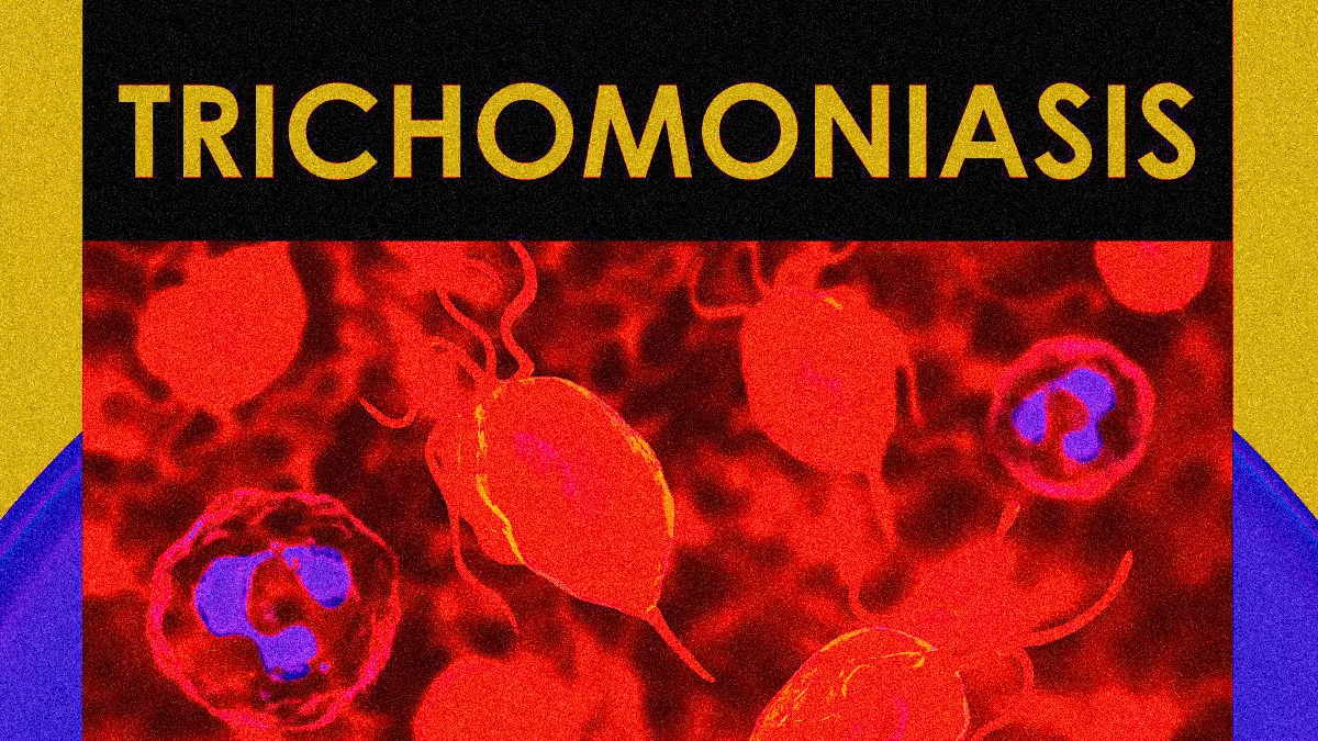 TRICHOMONIASIS