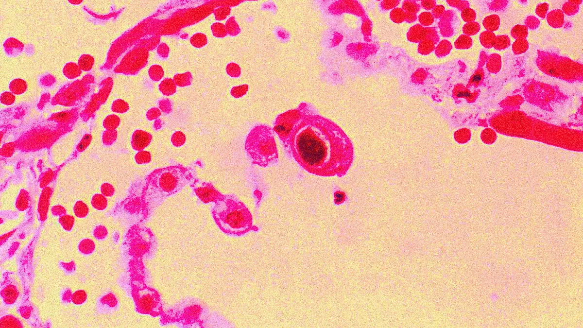 Cytomegalovirus (CMV)