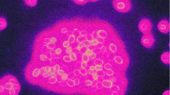 การติดเชื้อ Candida Glabrata (CG) - อาการ ภาวะแทรกซ้อน การตรวจและการรักษา