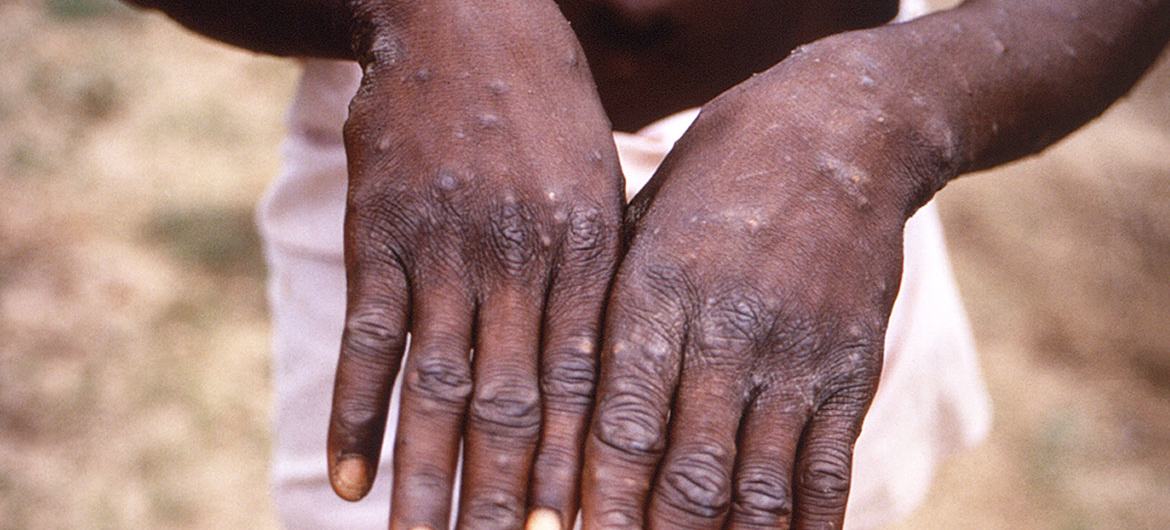 An unusual spread of Monkeypox and why you should pay attention to it.