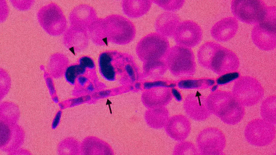 เชื้อ Candida parapsilosis (CP) สาเหตุที่ทำให้ภูมิคุ้มกันอ่อนแอ