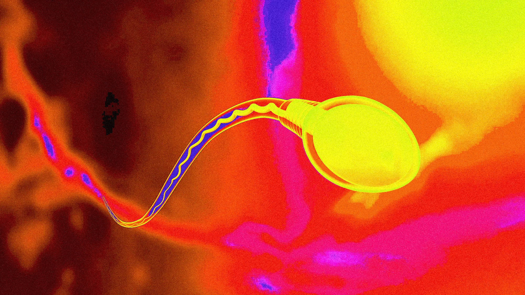 What Causes Infection in Sperm and Can We Detect the Infections with Sperm Analysis or Sperm PCR Test