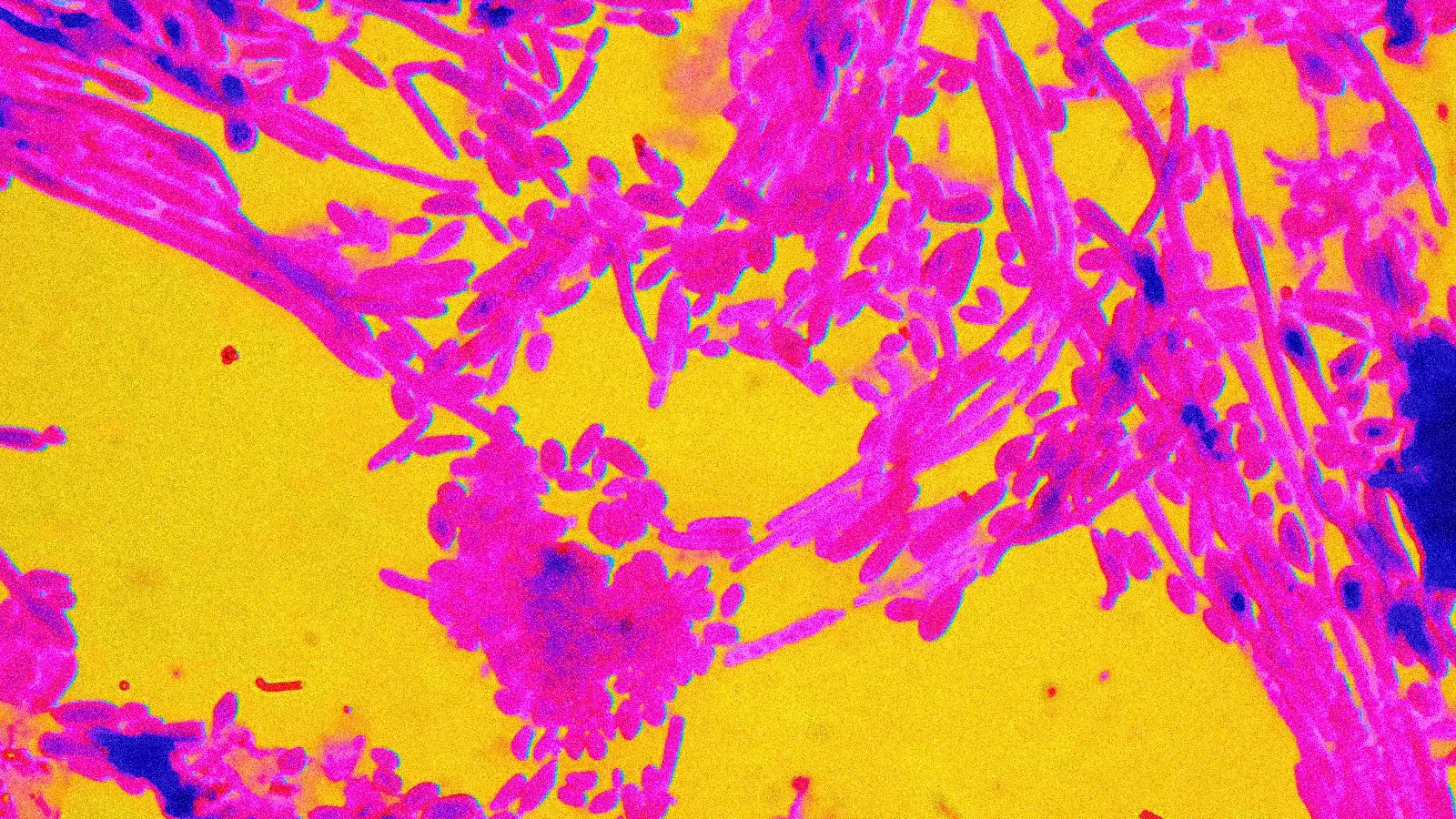 การติดเชื้อ Candida Bubliniensis - อาการ ภาวะแทรกซ้อน การตรวจโรคและการรักษา